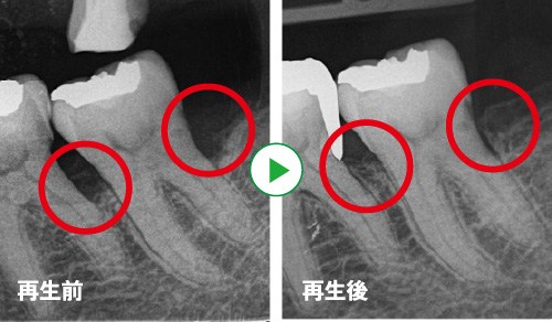 歯周組織再生法 画像