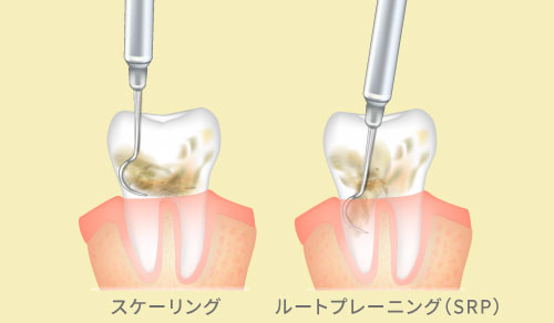 スケーリング＆ルートプレーニング（SRP） 画像