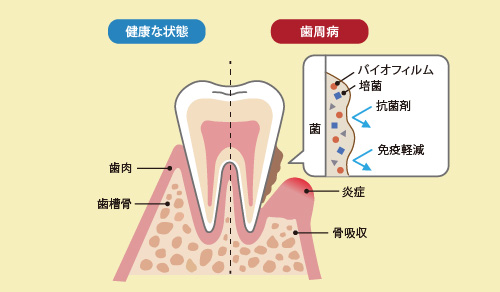 フラップ手術（歯周病進行度が中度~重度の場合） 画像